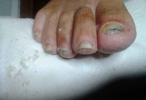 Лечение грибковых заболеваний ногтей ног луком