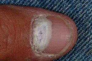 Дерматофиты или грибок ногтей симптомы 2