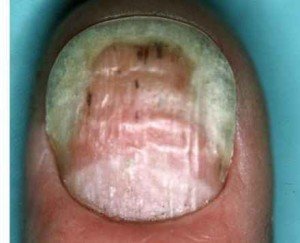 Дерматофиты или грибок ногтей симптомы 3