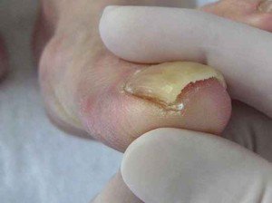 Выбор средства для лечения грибка ногтей на ногах