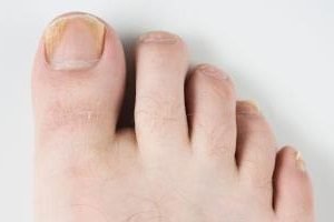 Выбор средства для лечения грибка ногтей на ногах 3